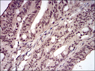 Immunohistochemical analysis of paraffin-embedded rectum cancer tissues using CCNE1 mouse mAb with DAB staining.