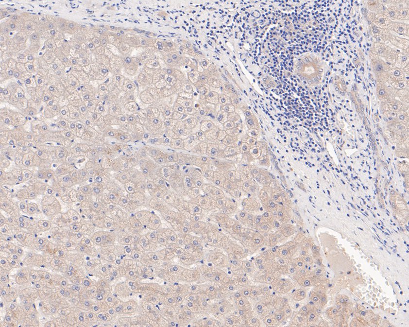 Fig5:; Immunohistochemical analysis of paraffin-embedded human liver tissue using anti-CLIC2 antibody. The section was pre-treated using heat mediated antigen retrieval with Tris-EDTA buffer (pH 9.0) for 20 minutes.The tissues were blocked in 1% BSA for 30 minutes at room temperature, washed with ddH; 2; O and PBS, and then probed with the primary antibody ( 1/400) for 30 minutes at room temperature. The detection was performed using an HRP conjugated compact polymer system. DAB was used as the chromogen. Tissues were counterstained with hematoxylin and mounted with DPX.