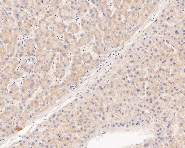 Fig3:; Immunohistochemical analysis of paraffin-embedded human liver carcinoma tissue using anti-TREM2 antibody. The section was pre-treated using heat mediated antigen retrieval with Tris-EDTA buffer (pH 8.0-8.4) for 20 minutes.The tissues were blocked in 5% BSA for 30 minutes at room temperature, washed with ddH; 2; O and PBS, and then probed with the primary antibody ( 1/200) for 30 minutes at room temperature. The detection was performed using an HRP conjugated compact polymer system. DAB was used as the chromogen. Tissues were counterstained with hematoxylin and mounted with DPX.