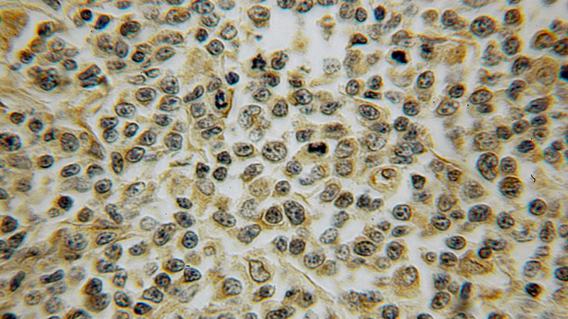 Immunohistochemical of paraffin-embedded human lymphoma using Catalog No:114325(LRP antibody) at dilution of 1:100 (under 10x lens)
