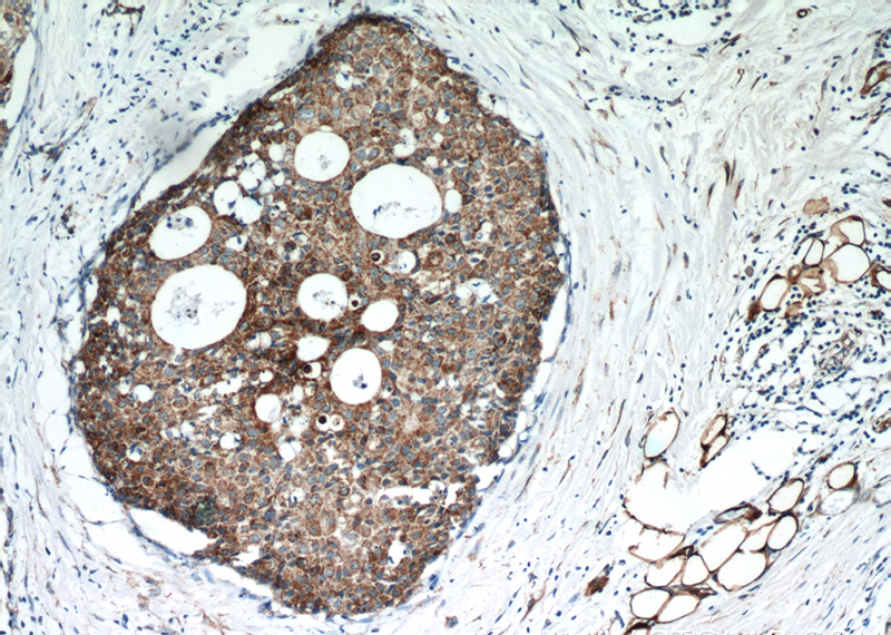 Immunohistochemical of paraffin-embedded human breast cancer using Catalog No:110438(FABP3 antibody) at dilution of 1:50 (under 10x lens)