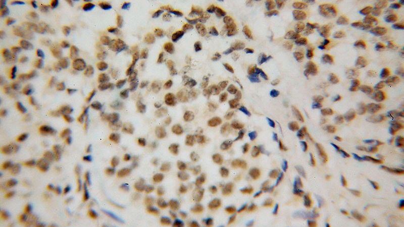 Immunohistochemical of paraffin-embedded human breast cancer using Catalog No:116463(U2AF2 antibody) at dilution of 1:50 (under 40x lens)