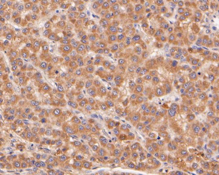 Fig4:; Immunohistochemical analysis of paraffin-embedded human liver carcinoma tissue using anti-Neurabin 1 antibody. The section was pre-treated using heat mediated antigen retrieval with Tris-EDTA buffer (pH 8.0-8.4) for 20 minutes.The tissues were blocked in 5% BSA for 30 minutes at room temperature, washed with ddH; 2; O and PBS, and then probed with the primary antibody ( 1/400) for 30 minutes at room temperature. The detection was performed using an HRP conjugated compact polymer system. DAB was used as the chromogen. Tissues were counterstained with hematoxylin and mounted with DPX.