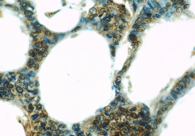 Immunohistochemistry of paraffin-embedded human colon cancer slide using Catalog No:107654(UBE2C Antibody) at dilution of 1:50