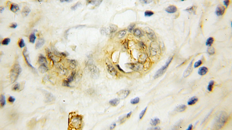 Immunohistochemical of paraffin-embedded human pancreas cancer using Catalog No:114655(RHCG antibody) at dilution of 1:50 (under 10x lens)