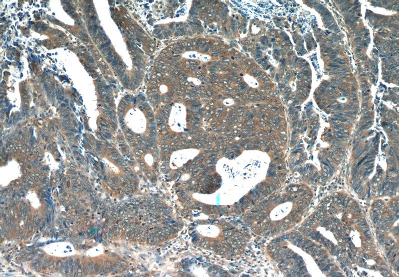 Immunohistochemistry of paraffin-embedded human colon cancer tissue slide using Catalog No:109103(CDC37 Antibody) at dilution of 1:50 (under 10x lens)