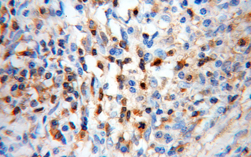 Immunohistochemical of paraffin-embedded human cervical cancer using Catalog No:109365(CFL1 antibody) at dilution of 1:50 (under 40x lens)