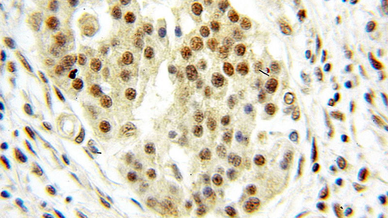 Immunohistochemical of paraffin-embedded human pancreas cancer using Catalog No:110014(DRAP1 antibody) at dilution of 1:50 (under 10x lens)