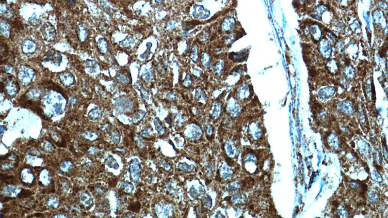 Immunohistochemical of paraffin-embedded human lung cancer using Catalog No:115731(STOML2 antibody) at dilution of 1:100 (under 40x lens)