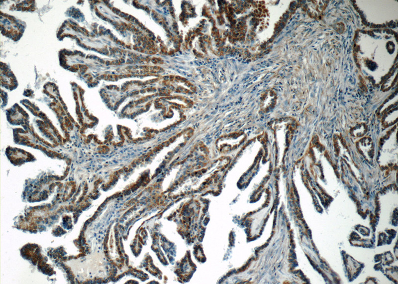 Immunohistochemistry of paraffin-embedded human thyroid cancer tissue slide using Catalog No:107823(ACAA1 Antibody) at dilution of 1:50 (under 10x lens)