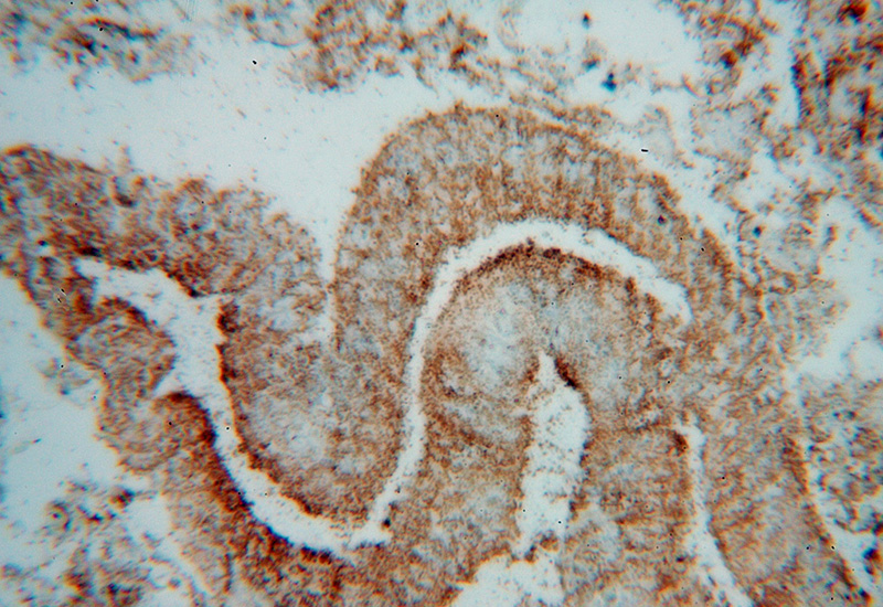 Immunohistochemical of paraffin-embedded human colon cancer using Catalog No:107881(ALPL antibody) at dilution of 1:100 (under 40x lens)