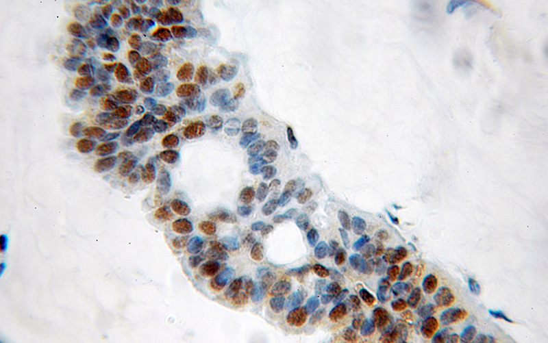Immunohistochemical of paraffin-embedded human breast cancer using Catalog No:111005(GNL2 antibody) at dilution of 1:50 (under 10x lens)