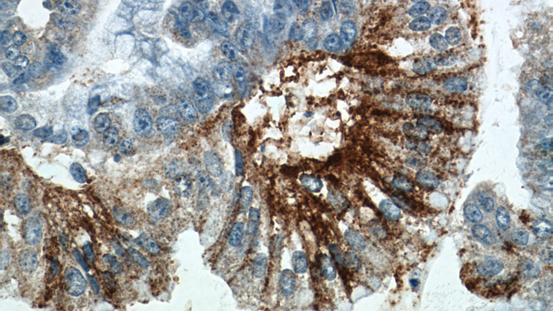 Immunohistochemistry of paraffin-embedded human ovary tumor tissue slide using Catalog No:109931(DHX35 Antibody) at dilution of 1:50 (under 40x lens)