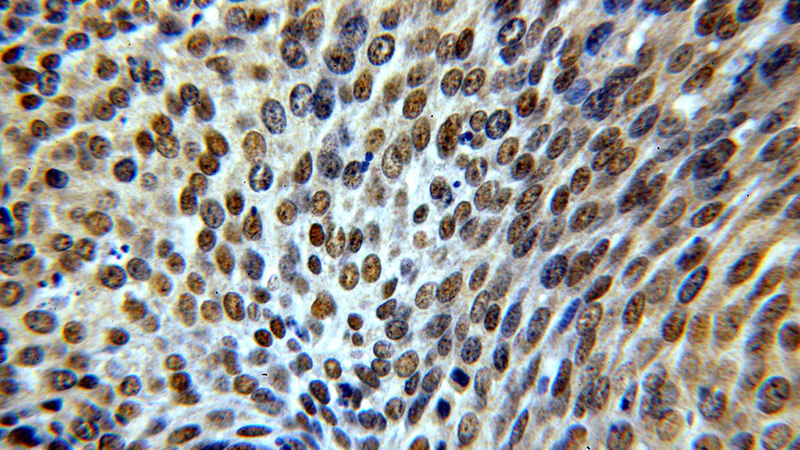 Immunohistochemical of paraffin-embedded human cervical cancer using Catalog No:115671(STAG2 antibody) at dilution of 1:100 (under 40x lens)