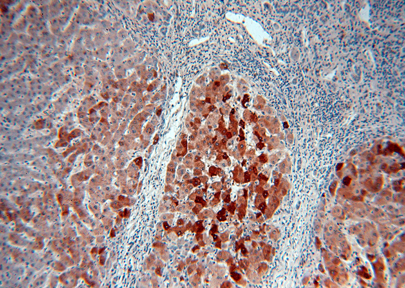 Immunohistochemical of paraffin-embedded human hepatocirrhosis using Catalog No:116114(THUMPD3 antibody) at dilution of 1:100 (under 10x lens)