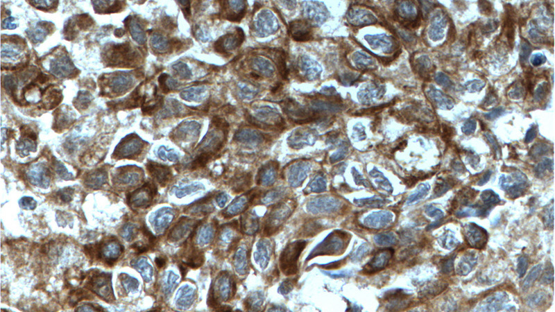 Immunohistochemistry of paraffin-embedded human lung cancer tissue slide using Catalog No:117105(Bcl-xL Antibody) at dilution of 1:200 (under 40x lens). heat mediated antigen retrieved with Tris-EDTA buffer(pH9).