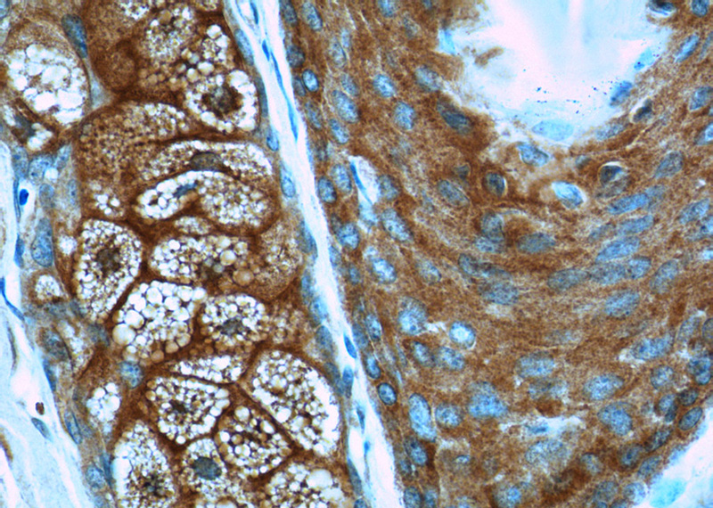 Immunohistochemistry of paraffin-embedded human skin cancer tissue slide using Catalog No:108235(ARAF Antibody) at dilution of 1:50 (under 40x lens)