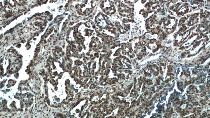Immunohistochemistry of paraffin-embedded human ovary tumor tissue slide using Catalog No:110556(FBXO5 Antibody) at dilution of 1:50