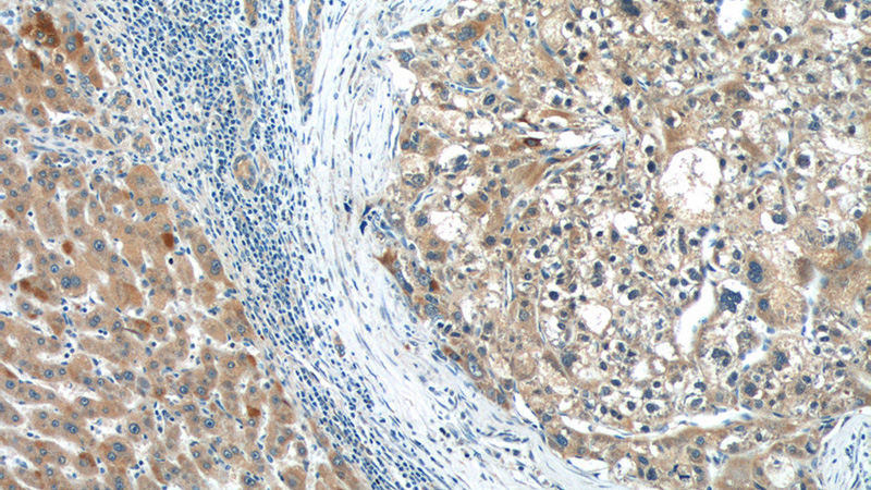 Immunohistochemistry of paraffin-embedded human liver cancer tissue slide using Catalog No:109203(CGNL1 Antibody) at dilution of 1:50 (under 10x lens)