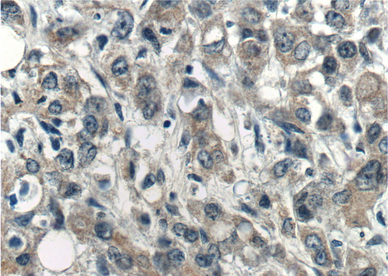 Immunohistochemistry of paraffin-embedded human stomach cancer tissue slide using Catalog No:116684(USP45 Antibody) at dilution of 1:200 (under 40x lens).