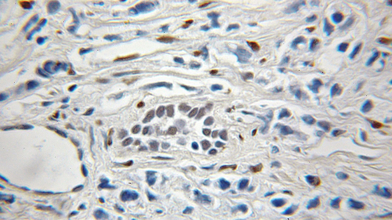 Immunohistochemical of paraffin-embedded human prostate cancer using Catalog No:111387(HDGFRP3 antibody) at dilution of 1:50 (under 10x lens)