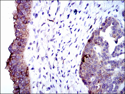 Immunohistochemical analysis of paraffin-embedded ovarian cancer tissues using TRA-2-54 mouse mAb with DAB staining.