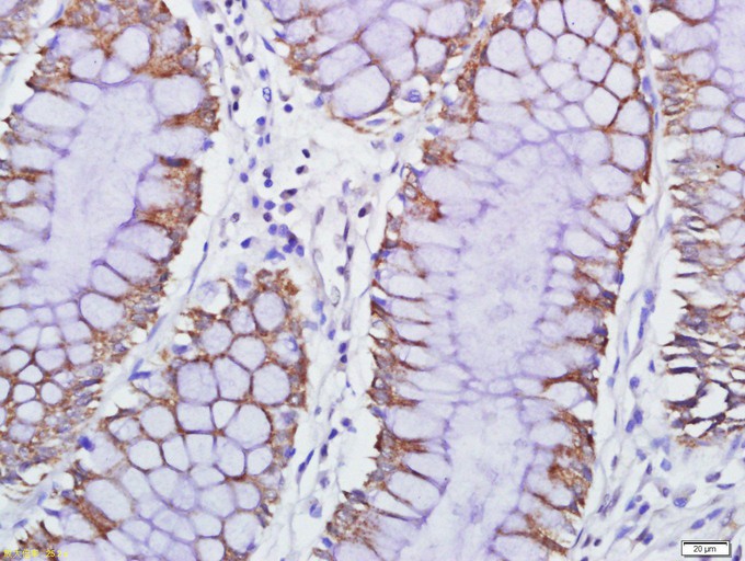 Fig1: Tissue/cell: human colon carcinoma; 4% Paraformaldehyde-fixed and paraffin-embedded;; Antigen retrieval: citrate buffer ( 0.01M, pH 6.0 ), Boiling bathing for 15min; Block endogenous peroxidase by 3% Hydrogen peroxide for 30min; Blocking buffer (normal goat serum,C-0005) at 37℃ for 20 min;; Incubation: Anti-GPCR EX33 Polyclonal Antibody, Unconjugated 1:500, overnight at 4℃, followed by conjugation to the secondary antibody(SP-0023) and DAB(C-0010) staining