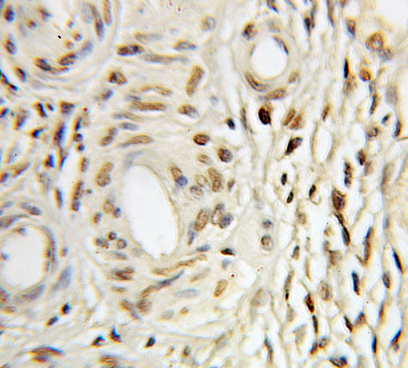 Immunohistochemical of paraffin-embedded human ovary tumor using Catalog No:115822(SUFU antibody) at dilution of 1:100 (under 10x lens)