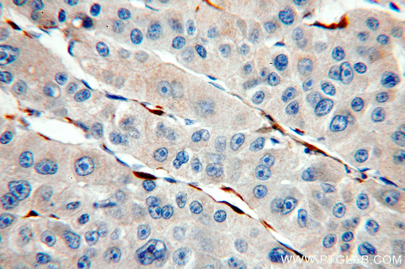Immunohistochemical of paraffin-embedded human liver cancer using Catalog No:109786(CYGB antibody) at dilution of 1:100 (under 40x lens)