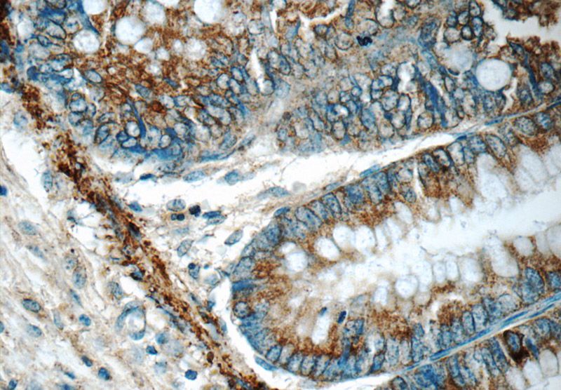 Immunohistochemistry of paraffin-embedded human colon tissue slide using Catalog No:108237(ARAP3 Antibody) at dilution of 1:50 (under 40x lens)