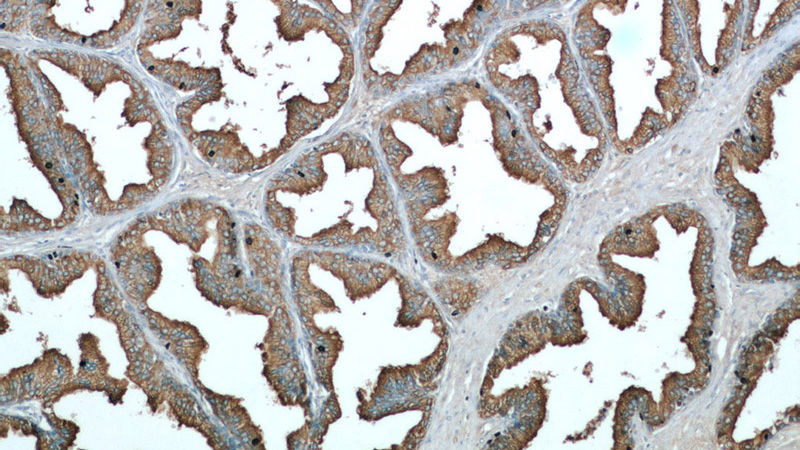 Immunohistochemical of paraffin-embedded human prostate hyperplasia using Catalog No:107558(ACPP antibody) at dilution of 1:50 (under 10x lens)