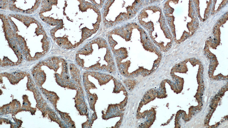 Immunohistochemical of paraffin-embedded human prostate hyperplasia using Catalog No:107558(ACPP antibody) at dilution of 1:50 (under 10x lens)