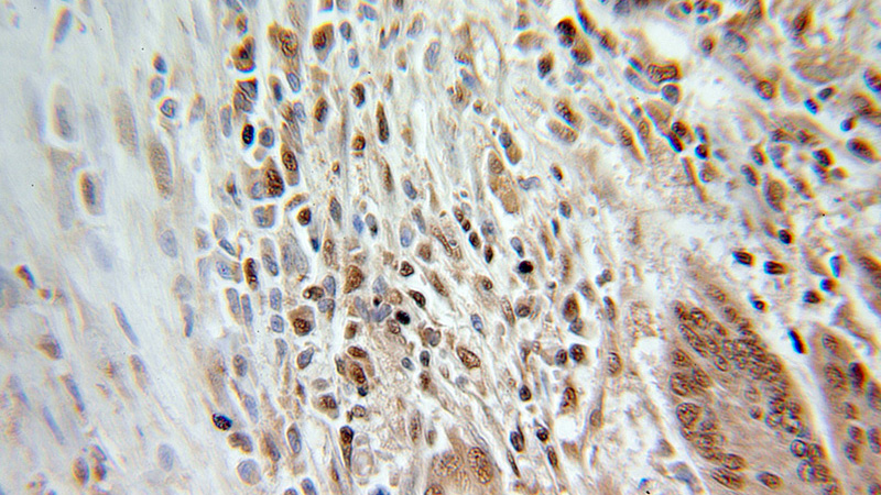 Immunohistochemical of paraffin-embedded human colon cancer using Catalog No:111098(GMFB antibody) at dilution of 1:100 (under 25x lens)