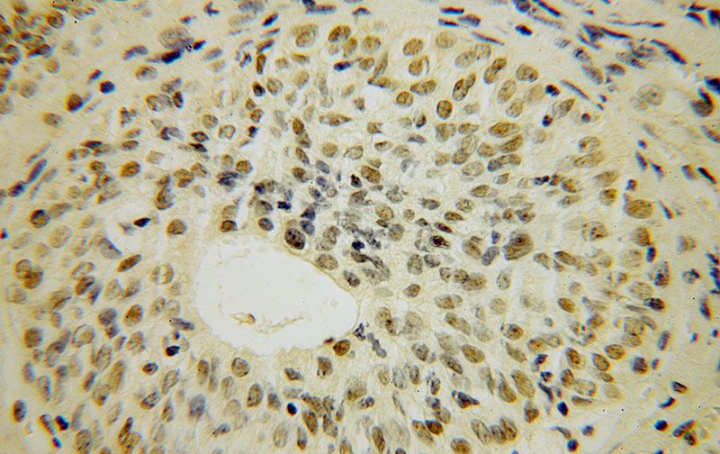 Immunohistochemical of paraffin-embedded human colon cancer using Catalog No:116166(TOE1 antibody) at dilution of 1:50 (under 40x lens)