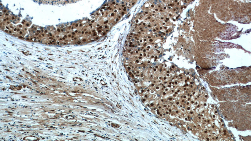 Immunohistochemistry of paraffin-embedded human breast cancer tissue slide using Catalog No:115662(SRA1 Antibody) at dilution of 1:50 (under 10x lens)