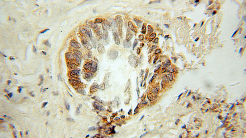 Immunohistochemical of paraffin-embedded human prostate cancer using Catalog No:114887(RPL3 antibody) at dilution of 1:10 (under 10x lens)