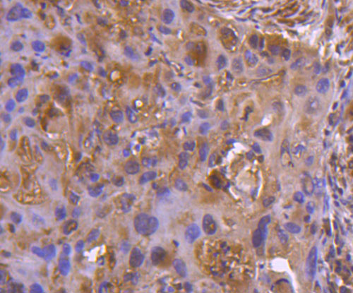 Fig3: Immunohistochemical analysis of paraffin-embedded human lung cancer tissue using anti-Osteoprotegerin antibody. Counter stained with hematoxylin.