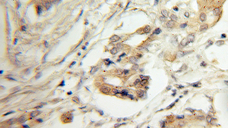 Immunohistochemical of paraffin-embedded human pancreas cancer using Catalog No:117187(BLNK antibody) at dilution of 1:100 (under 10x lens)