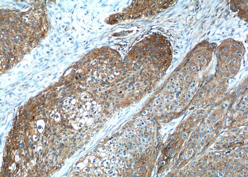 Immunohistochemistry of paraffin-embedded human oesophagus cancer tissue slide using Catalog No:117131(B2M Antibody) at dilution of 1:50 (under 10x lens)