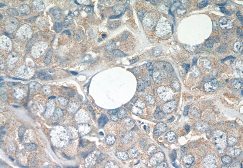 Immunohistochemistry of paraffin-embedded human breast cancer tissue slide using Catalog No:108284(ATF2-Specific Antibody) at dilution of 1:50 (under 40x lens)