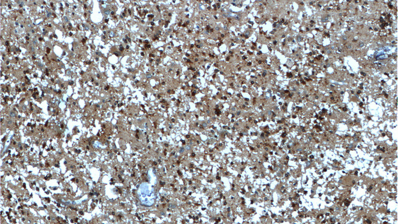 Immunohistochemistry of paraffin-embedded human gliomas tissue slide using Catalog No:117113(BDNF Antibody) at dilution of 1:200 (under 10x lens).