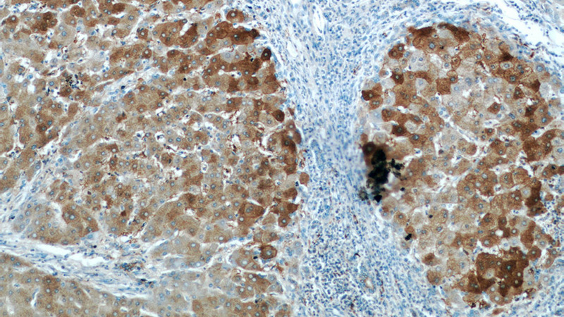 Immunohistochemical of paraffin-embedded human hepatocirrhosis using Catalog No:112361(LTBR antibody) at dilution of 1:50 (under 10x lens)