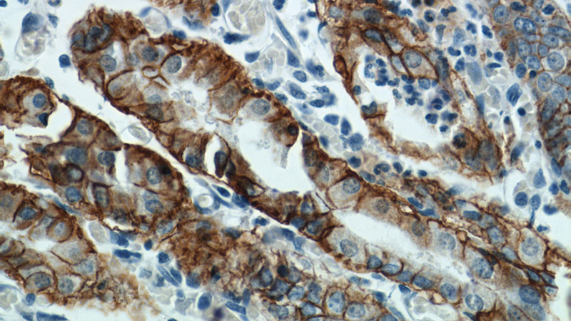 Immunohistochemistry of paraffin-embedded human stomach tissue slide using Catalog No:108808(CA9 Antibody) at dilution of 1:50 (under 40x lens)