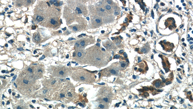 Immunohistochemistry of paraffin-embedded human hepatocirrhosis tissue slide using Catalog No:108830(CALM2 Antibody) at dilution of 1:50 (under 40x lens)