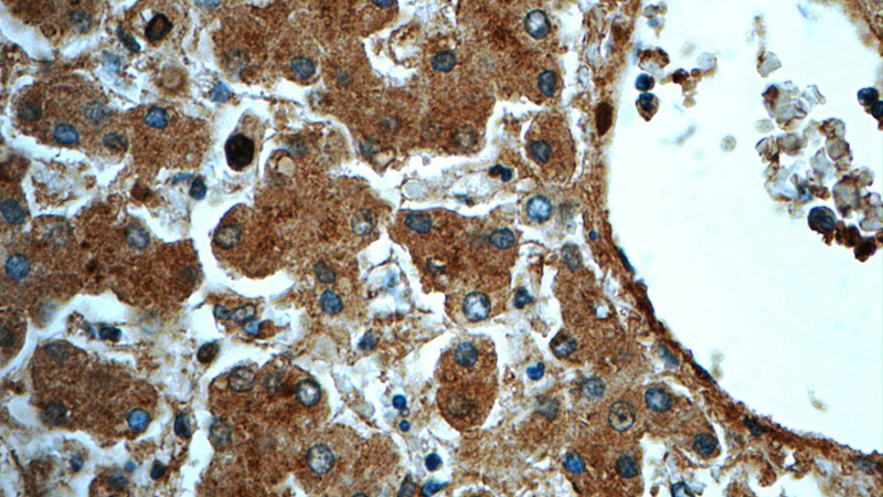 Immunohistochemistry of paraffin-embedded human liver tissue slide using Catalog No:113096(NEDD4 Antibody) at dilution of 1:50
