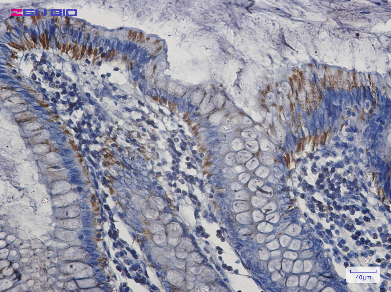 Immunohistochemistry of Bak in paraffin-embedded Human colon cancer tissue using Bak Rabbit pAb at dilution 1/20