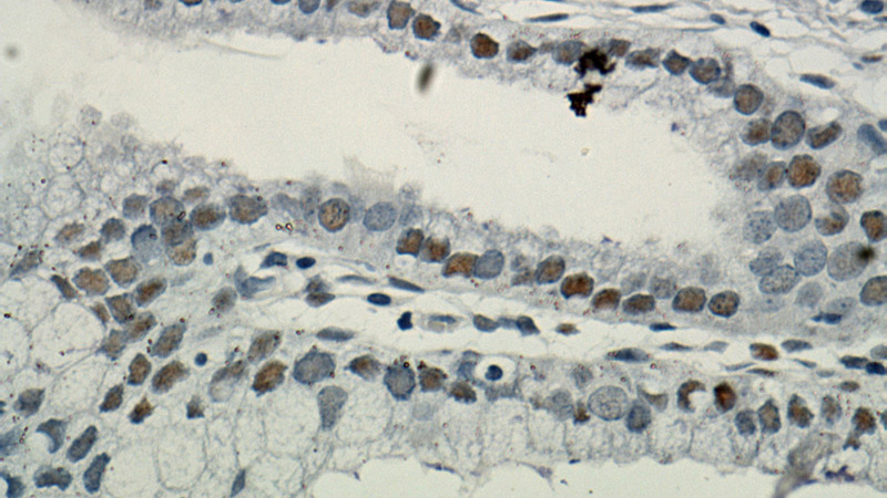 Immunohistochemical of paraffin-embedded human cervix using Catalog No:110397(ESR1 antibody) at dilution of 1:50 (under 40x lens). Heat mediated antigen retrieved with Citric acid buffer, pH6.0