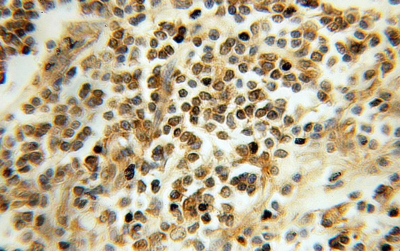Immunohistochemical of paraffin-embedded human colon cancer using Catalog No:115901(TCEB2 antibody) at dilution of 1:100 (under 10x lens)