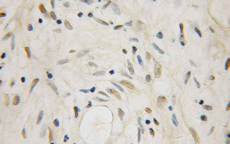 Immunohistochemical of paraffin-embedded human ovary tumor using Catalog No:114939(RUVBL1 antibody) at dilution of 1:50 (under 10x lens)