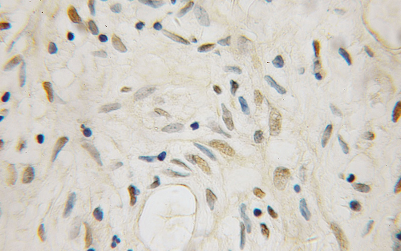 Immunohistochemical of paraffin-embedded human ovary tumor using Catalog No:114939(RUVBL1 antibody) at dilution of 1:50 (under 10x lens)